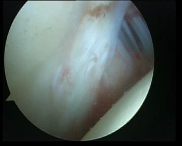 Arthroscopy Normal Anterior Labrum